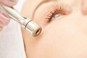 Microdermabrasion wand treatment on facial skin demonstrating precise vacuum suction and exfoliation